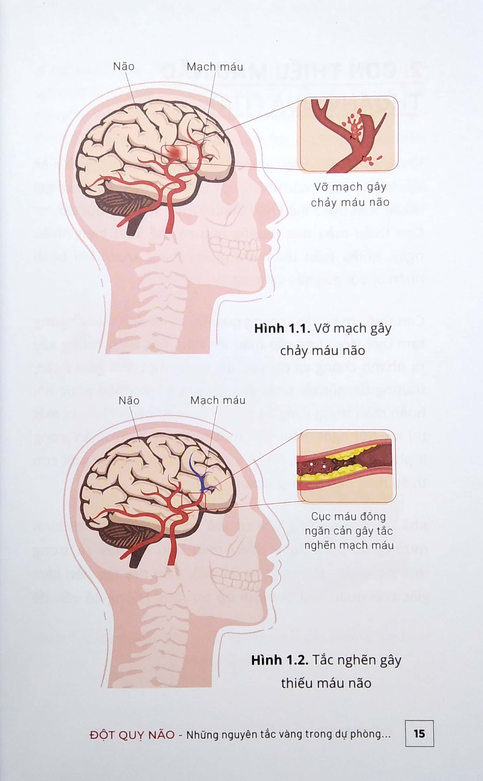Đột Quỵ Não - Những Nguyên Tắc Vàng Trong Dự Phòng Và Chăm Sóc Đột Quỵ PDF
